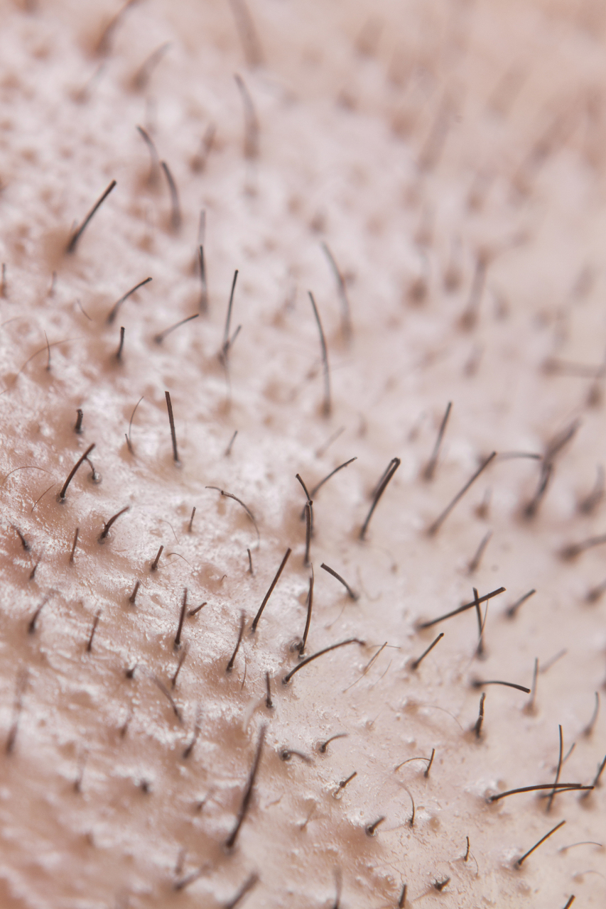 和男同事共住酒店被感染阴虱?了解这些症状和预防措施!