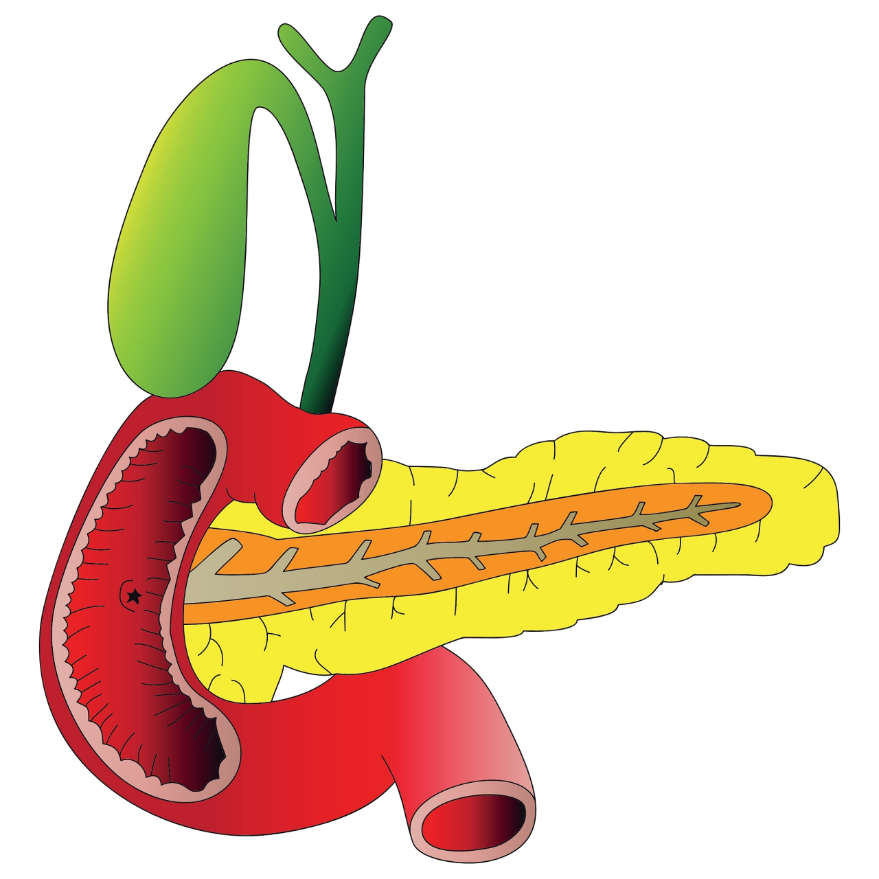 通常胆囊结石结石发作的时候典型的症状右上腹部疼痛,有时候表现为上