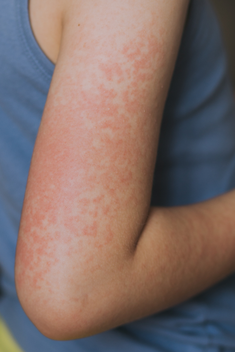 一个不起眼的"红疹",疼起来竟让人痛不欲生!