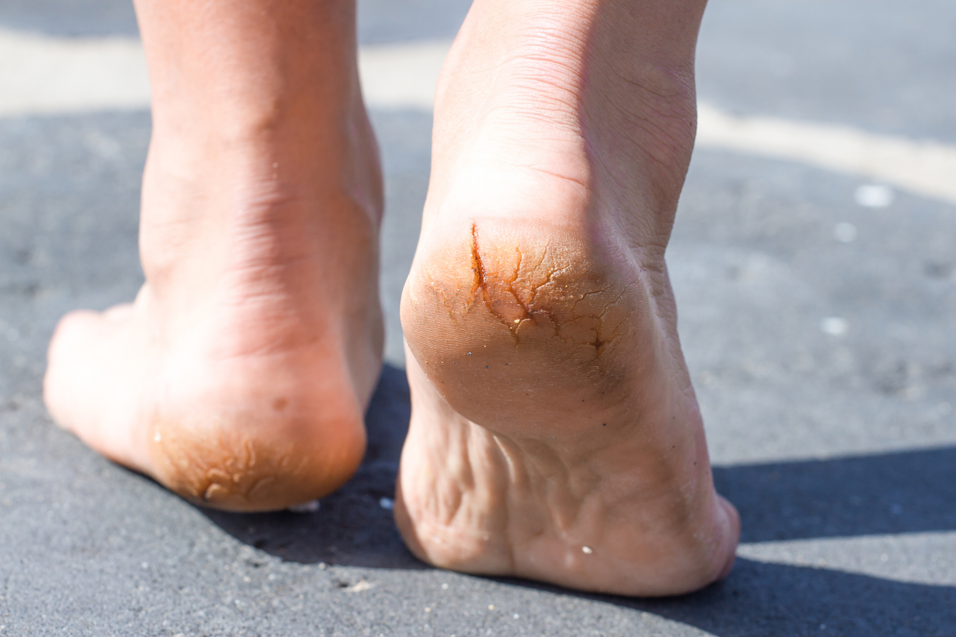 1,冻疮膏:该药物主要成分为樟脑,硼酸,甘油,主要