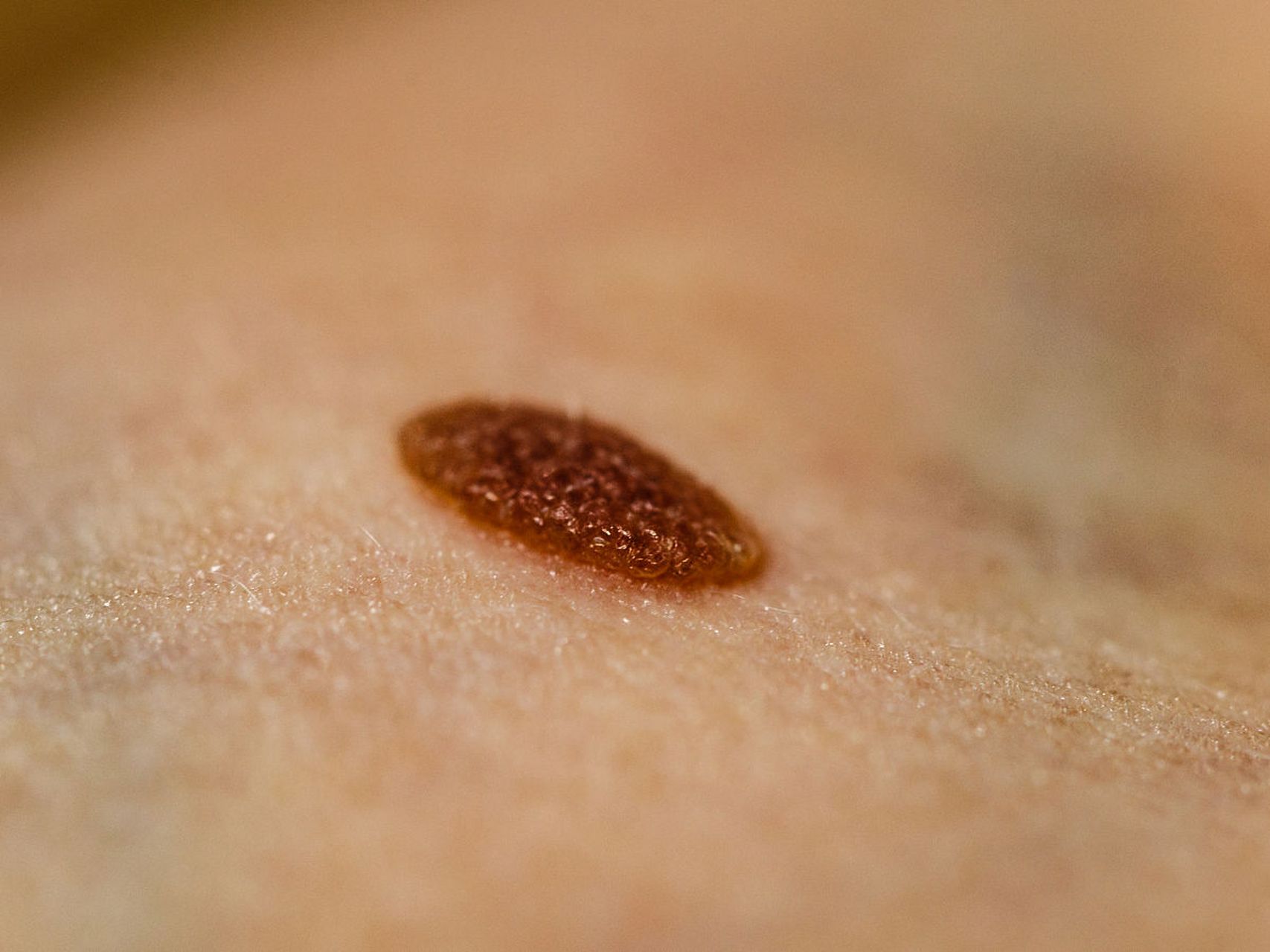 脸上去痣多少钱 #医美科普挑战赛# #激光祛痣#   一般来说,如果痣的