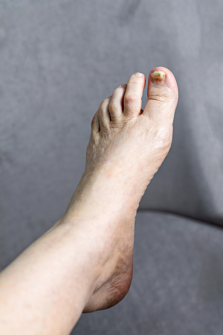 肝脏不好,脚告诉你,很多人都忽略了  一,脚掌心发白:肝脏造血功能  二