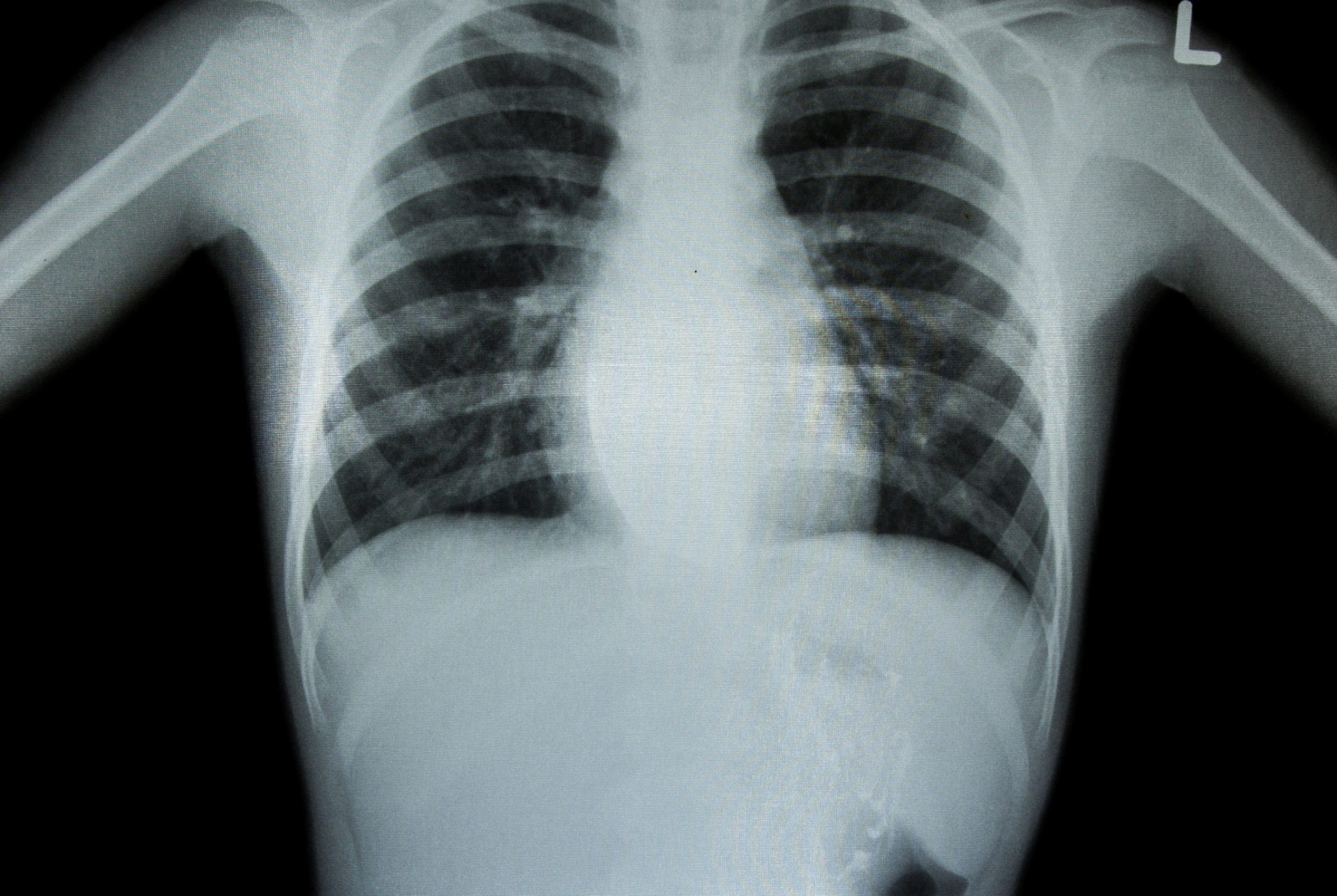胸部x光检查:如何准备,进行和解读检查结果 胸部x光检查是一种非常