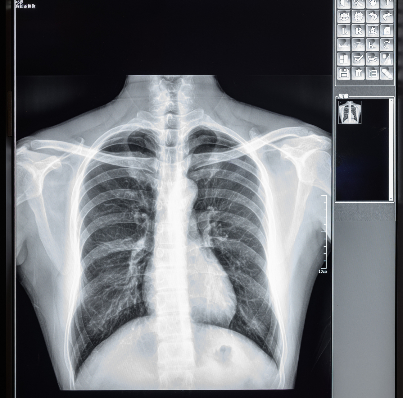 肺ct报告单上潜台词,你看的懂吗? 1.
