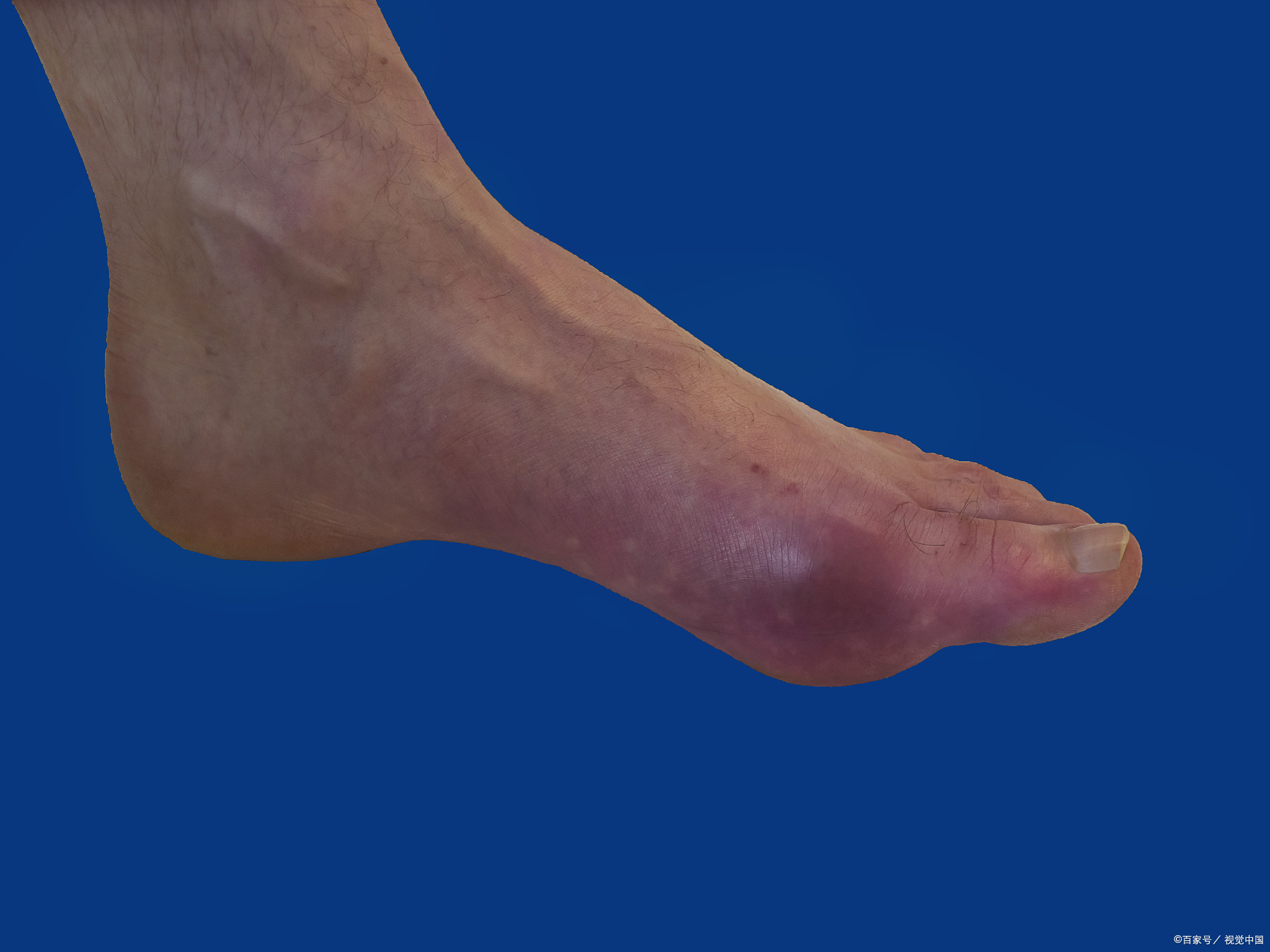 3%,患病人群约1.77亿,痛风总体发病率为1.1%,患病人数约为1466万.