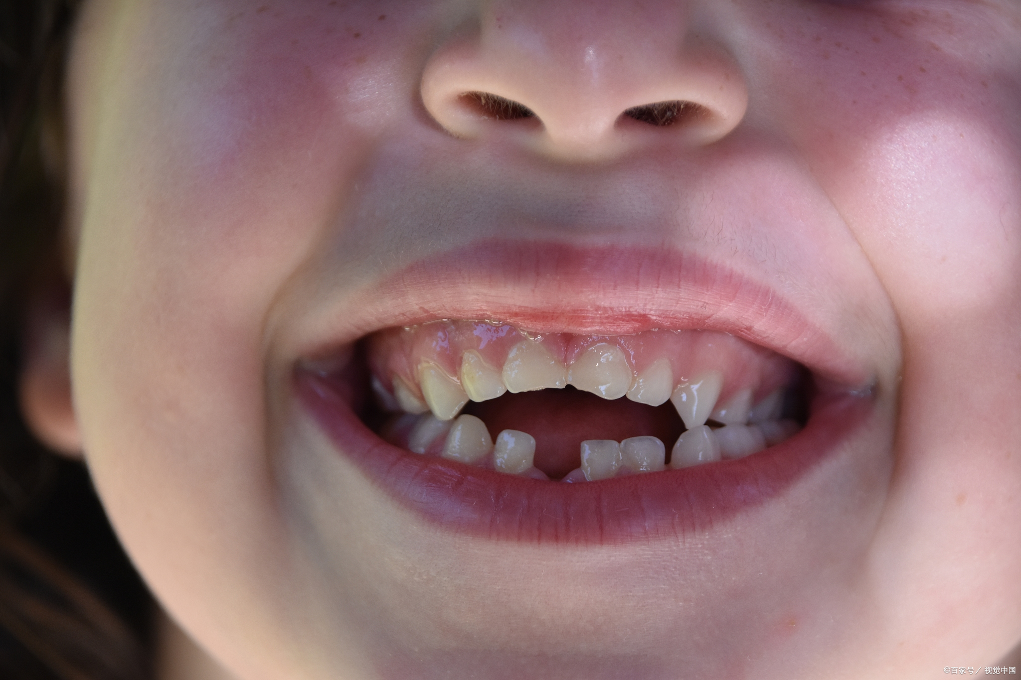 对于轻度倾斜,可采用树脂或瓷贴面矫正,改变牙齿邻接点和倾斜角度