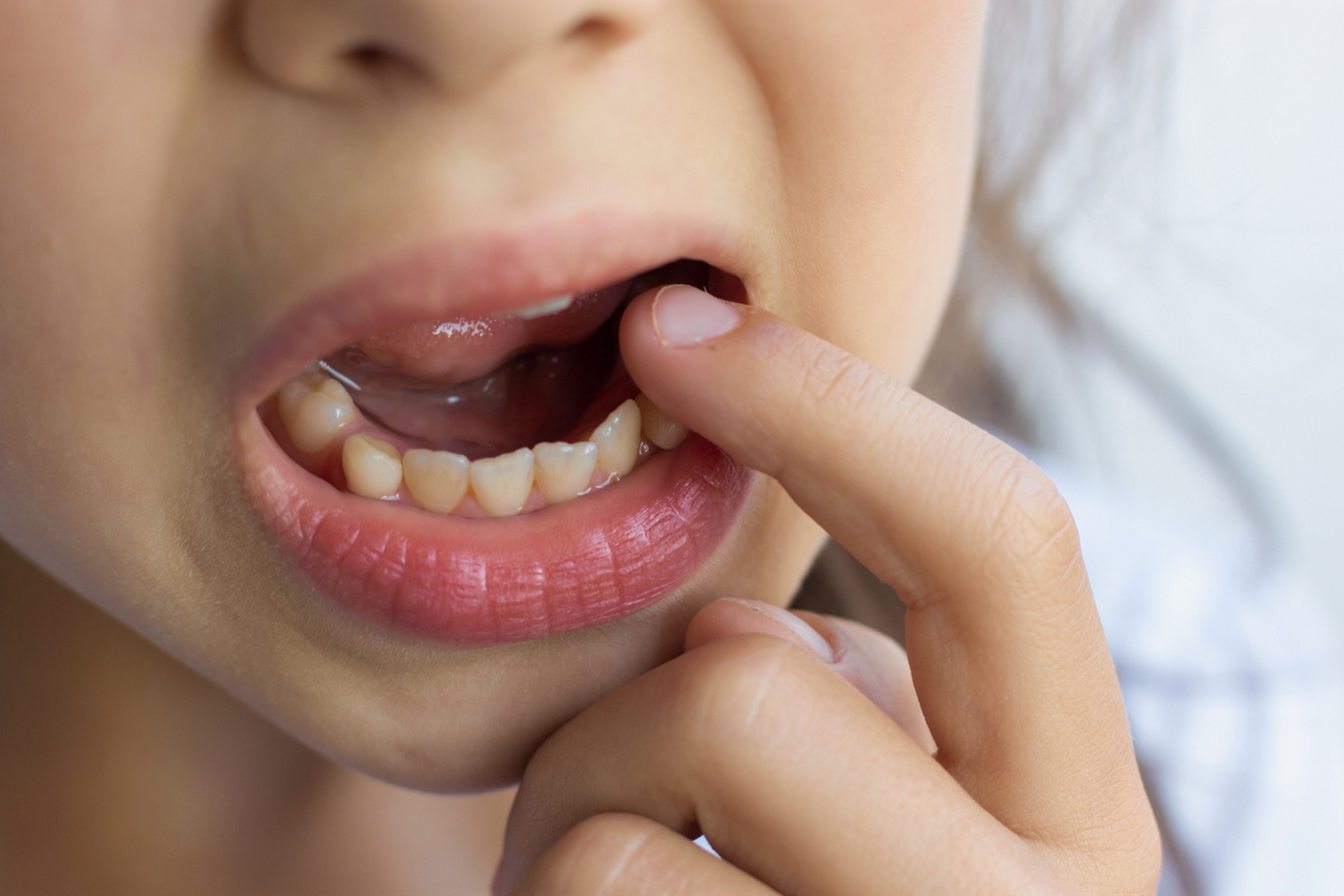 宝宝牙齿摔松动了能恢复吗  宝宝牙齿摔松动了,分为乳牙震荡和半脱位