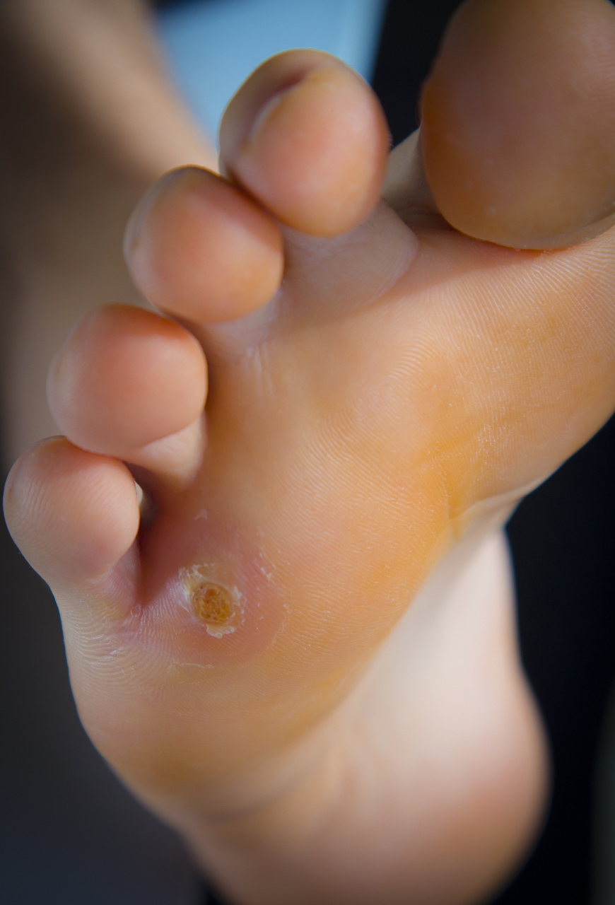脚上长鸡眼?医生教你轻松应对!