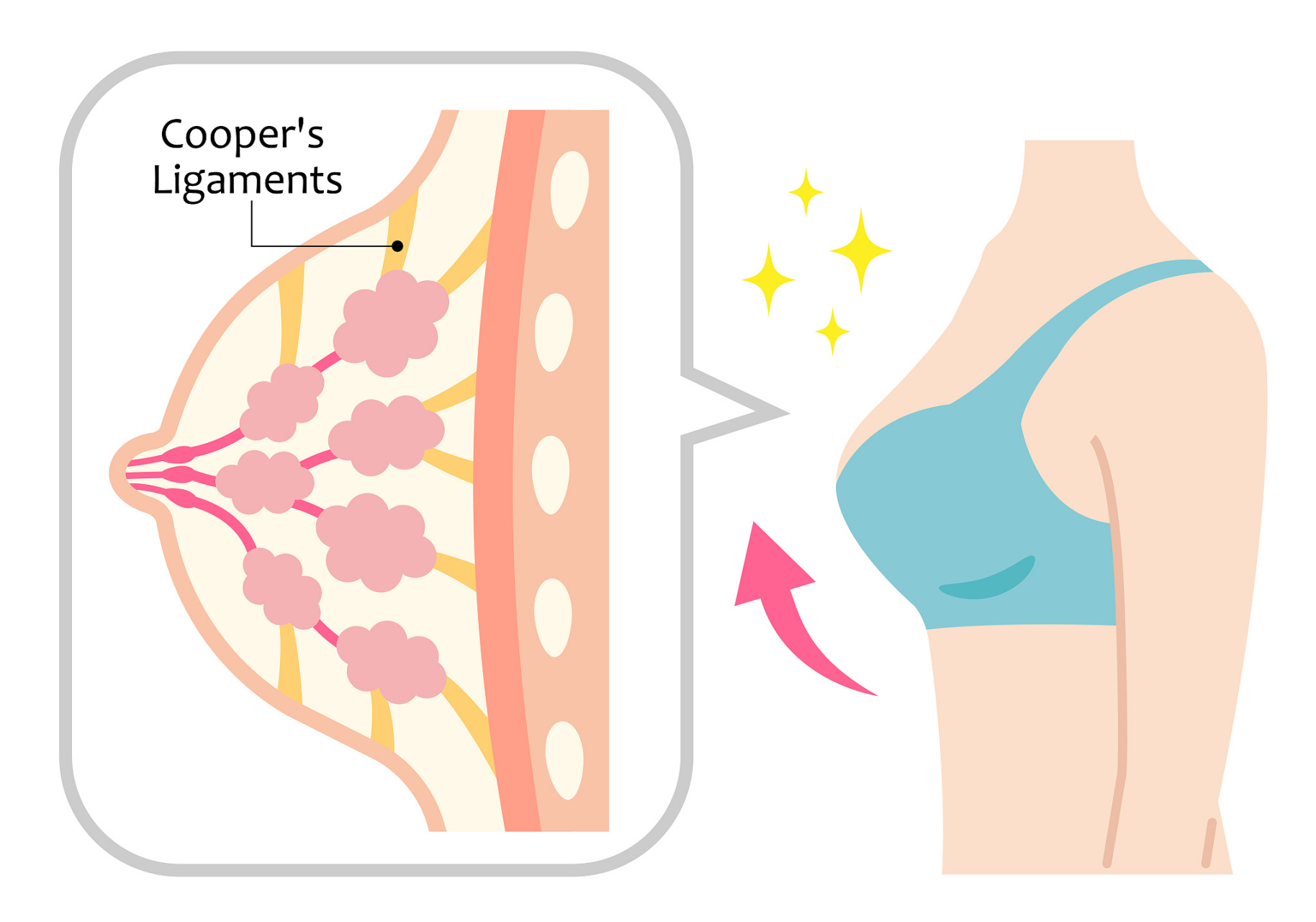 通过乳房上提术,可以改善乳房的形态,使其更加挺拔和丰满,同时还可以
