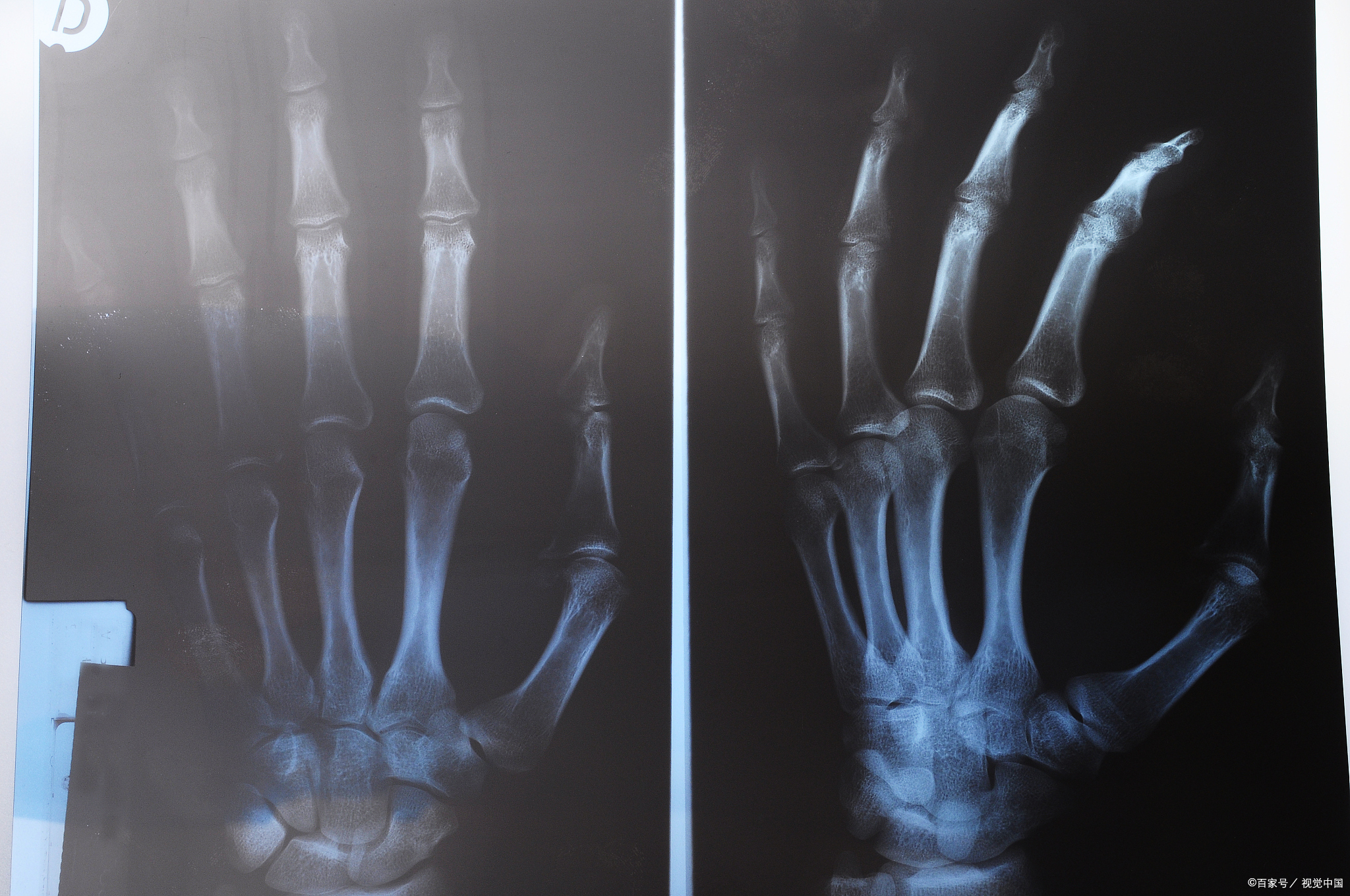 老年人骨骼比较脆弱,保护骨骼,须做好这几件事