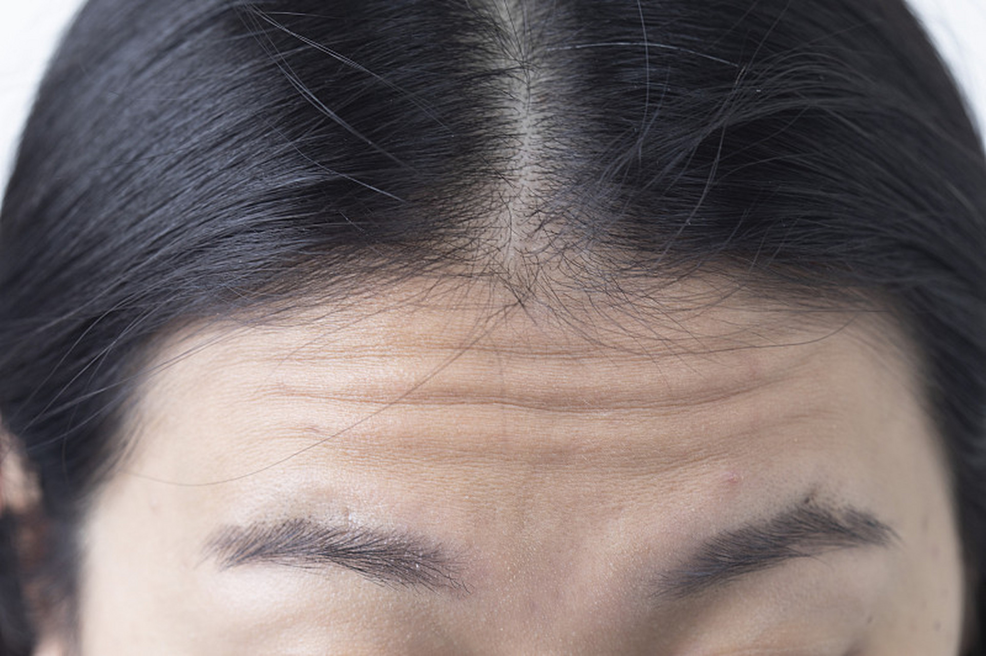 额头除皱针副作用:消失时间因人而异  额头除皱针注射后,可能会出现的