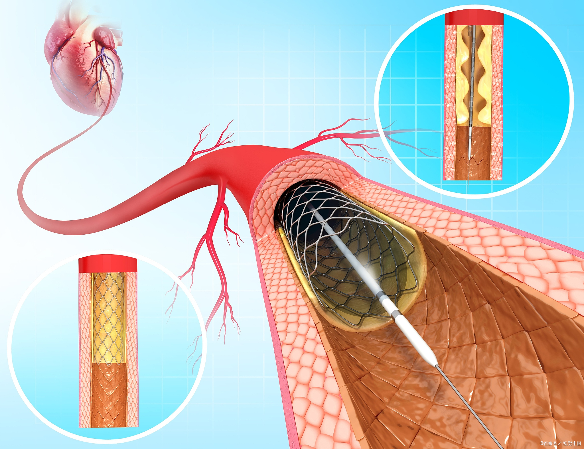 心脏支架位置图片