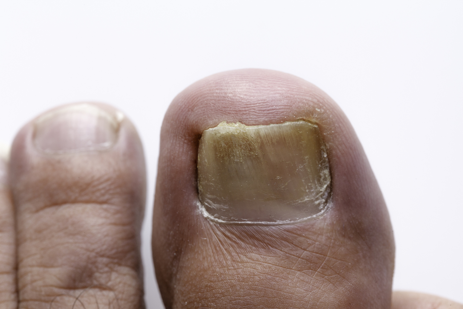 甲沟炎是指甲周发生炎症的疾病,易发生在指甲和指间的皮肤处.