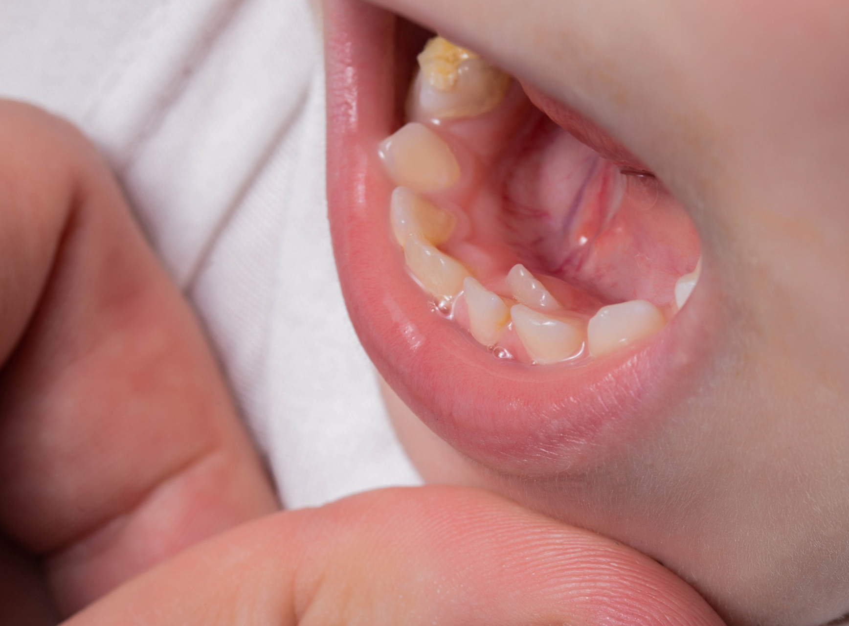 乳牙滞留是口腔健康隐藏杀手,它可能对孩子的牙齿产生严重的影响.