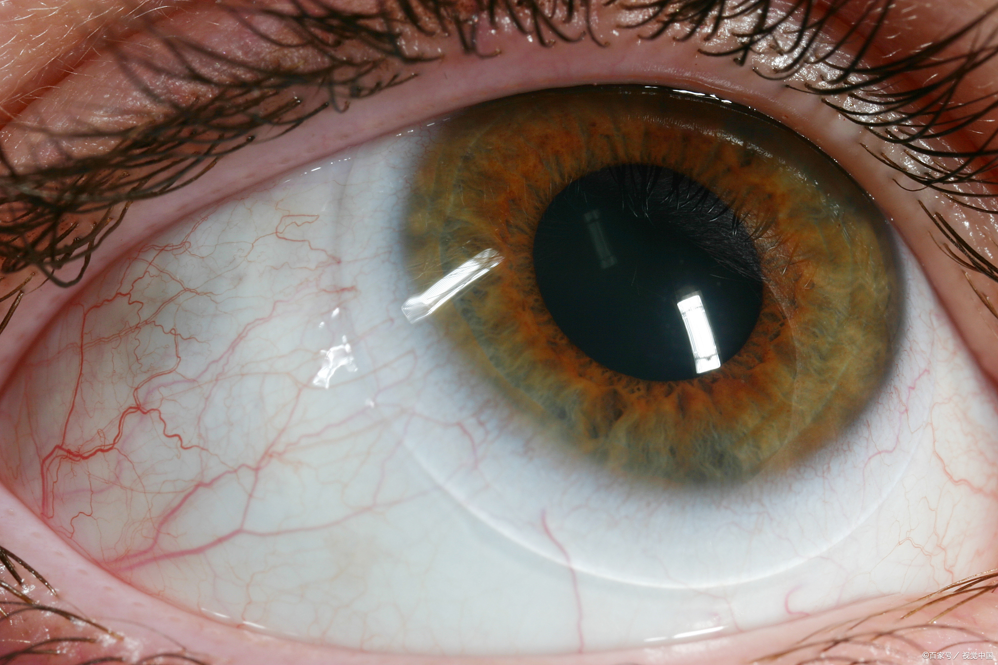 当角膜受炎症影响时,常出现畏光,流泪不止等症状,伴随眼红或视力模糊