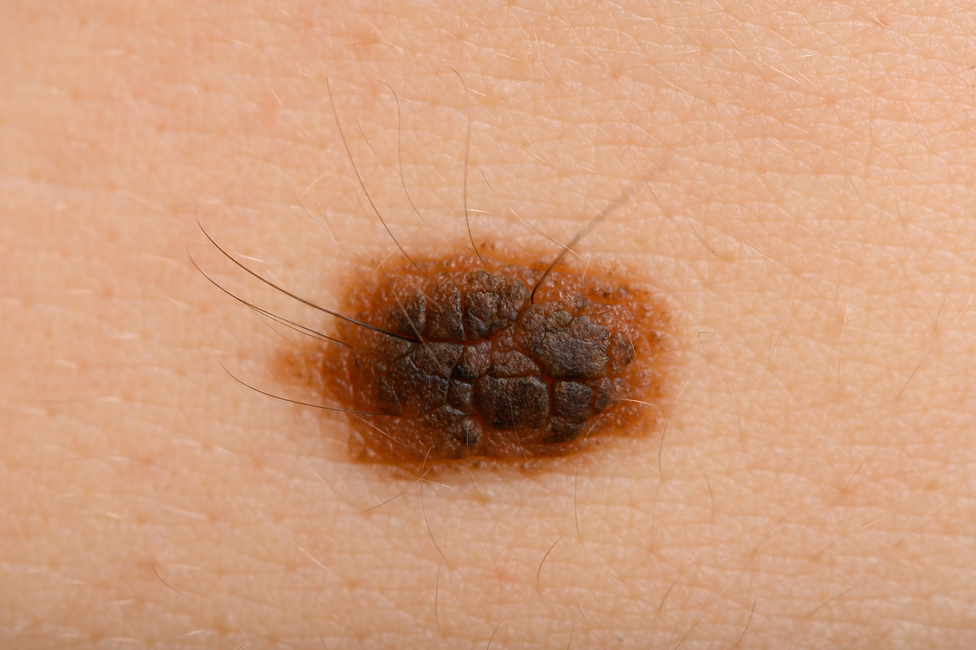 常见的五种痣的类型,前两种用激光就可以解决.