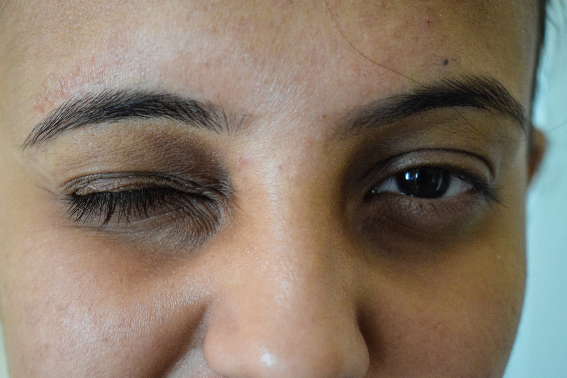 羊眼圈  羊眼圈是指眼部周围的皮肤出现凹陷和暗沉的情况,类似于羊眼