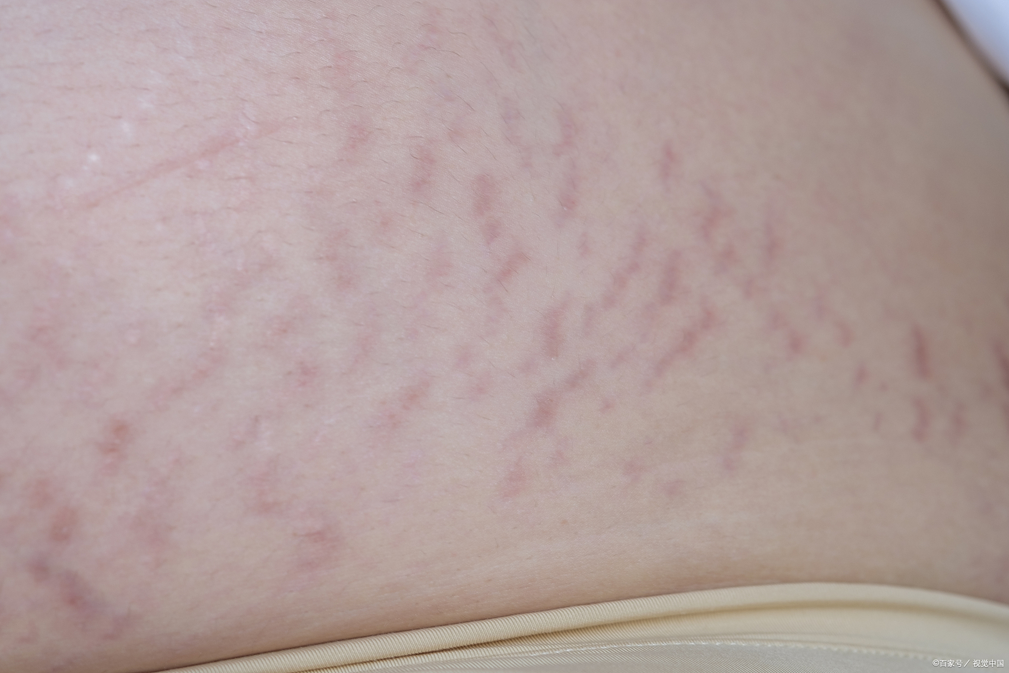 38岁孕妇出现妊娠纹,医生揭秘:预防关键在孕早期这3周