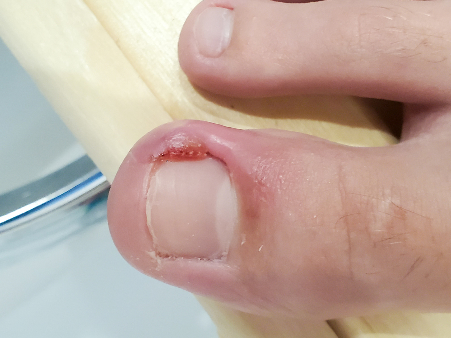 大拇指的指甲往肉里长,最常见的原因是由于大拇指的负重功能最强