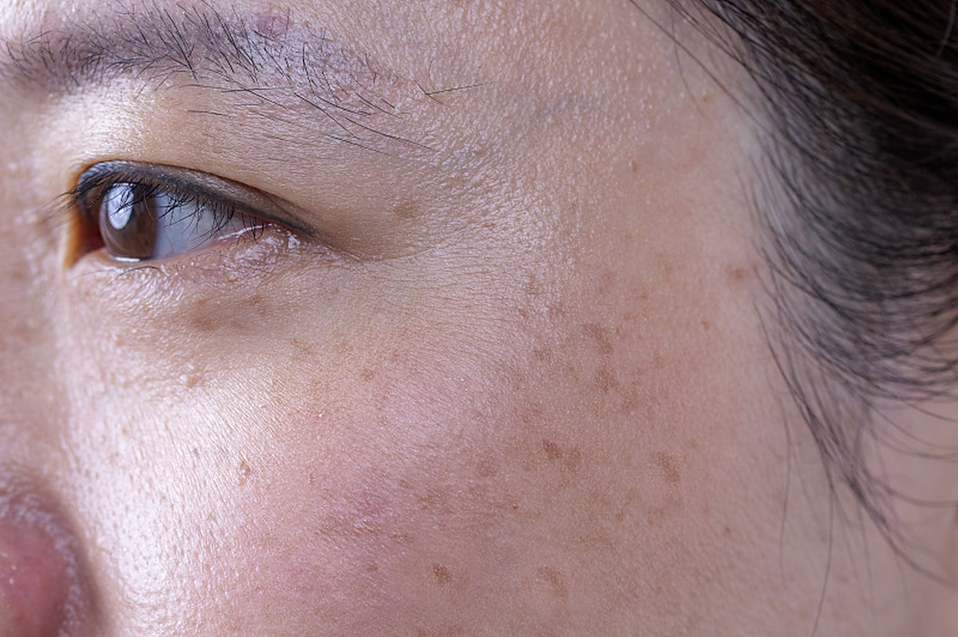 皮肤容易长斑,这几种体质,在作怪!  大家好,我是中医屠远辉.中医认为,