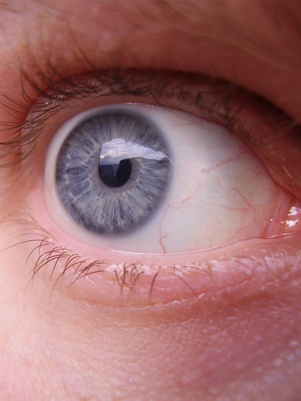 首先,黄斑水肿的病理机制在于眼部血管的异常渗透,导致液体在