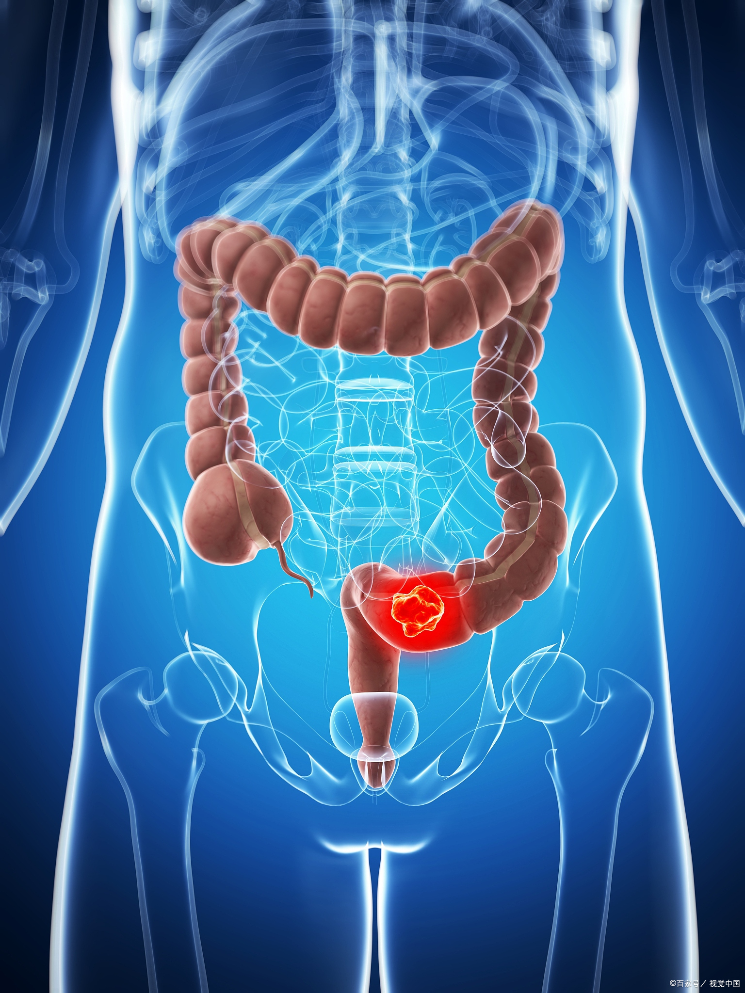 乙状结肠癌患者,如何治疗才能避免复发?