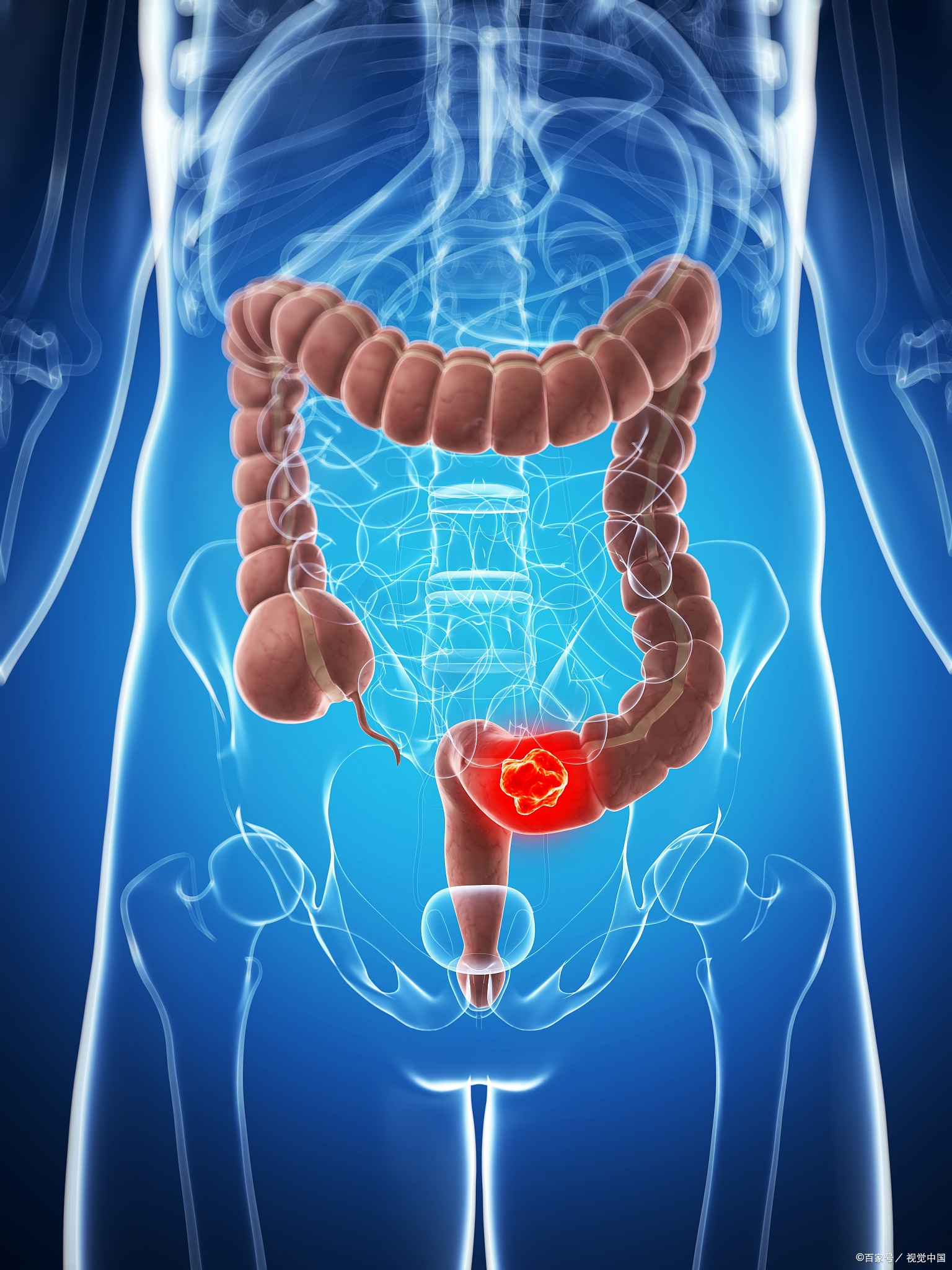 结肠癌位置图图片