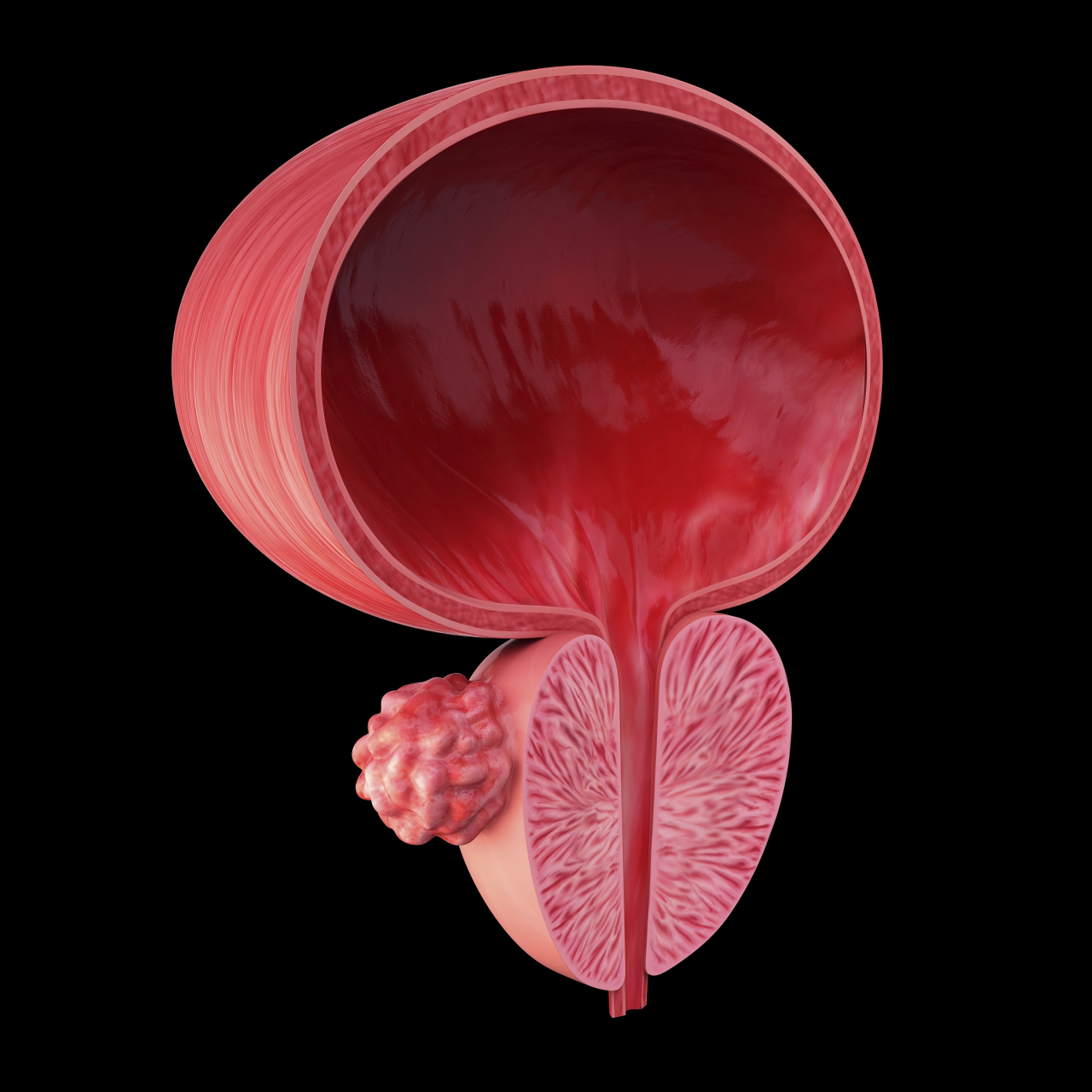 尿道狭窄与生育那些事儿:详解影响及应对策略  "医生,我结婚两年了