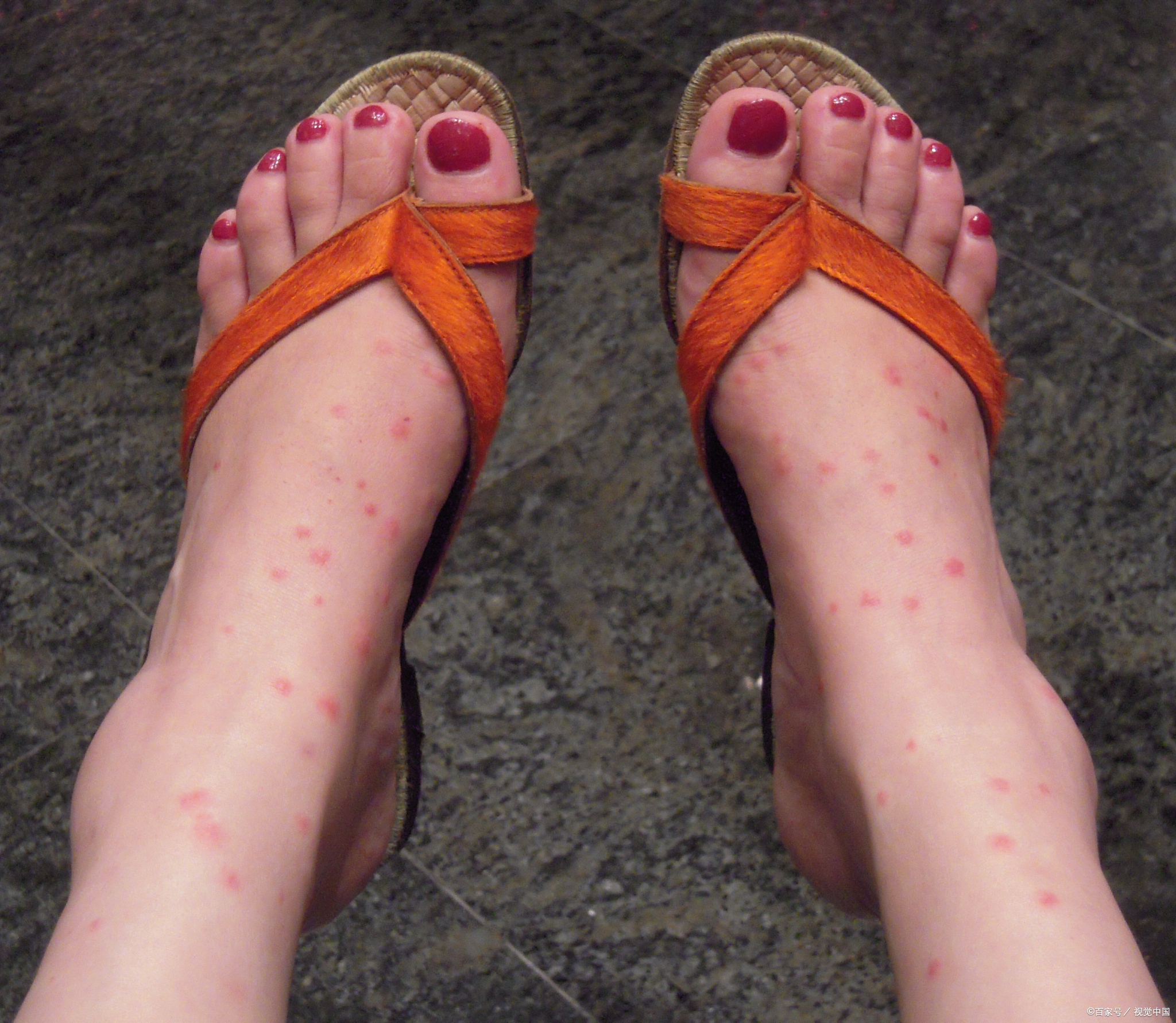 夏季虫咬,当心皮炎爬上身