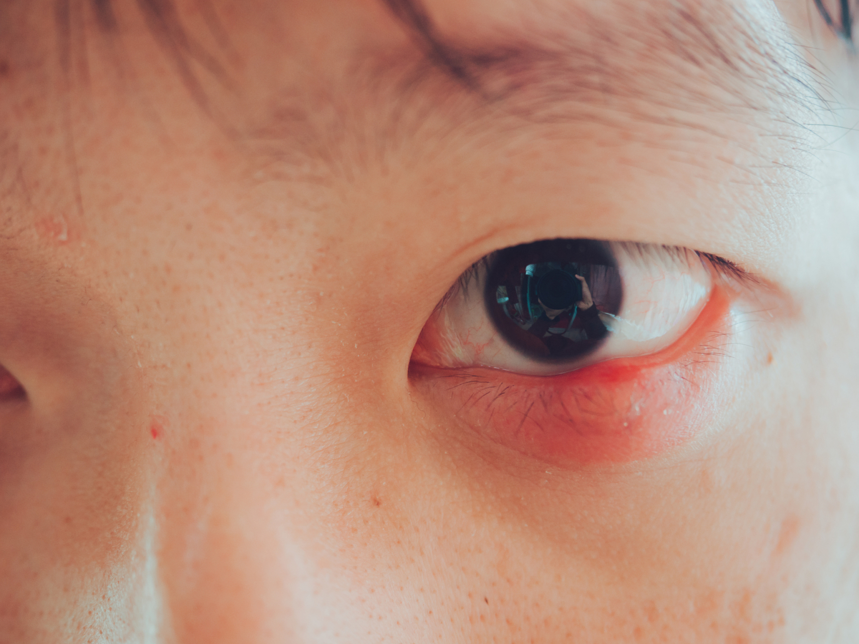 眼部红肿痒,可能是过敏性结膜炎或睑皮炎.