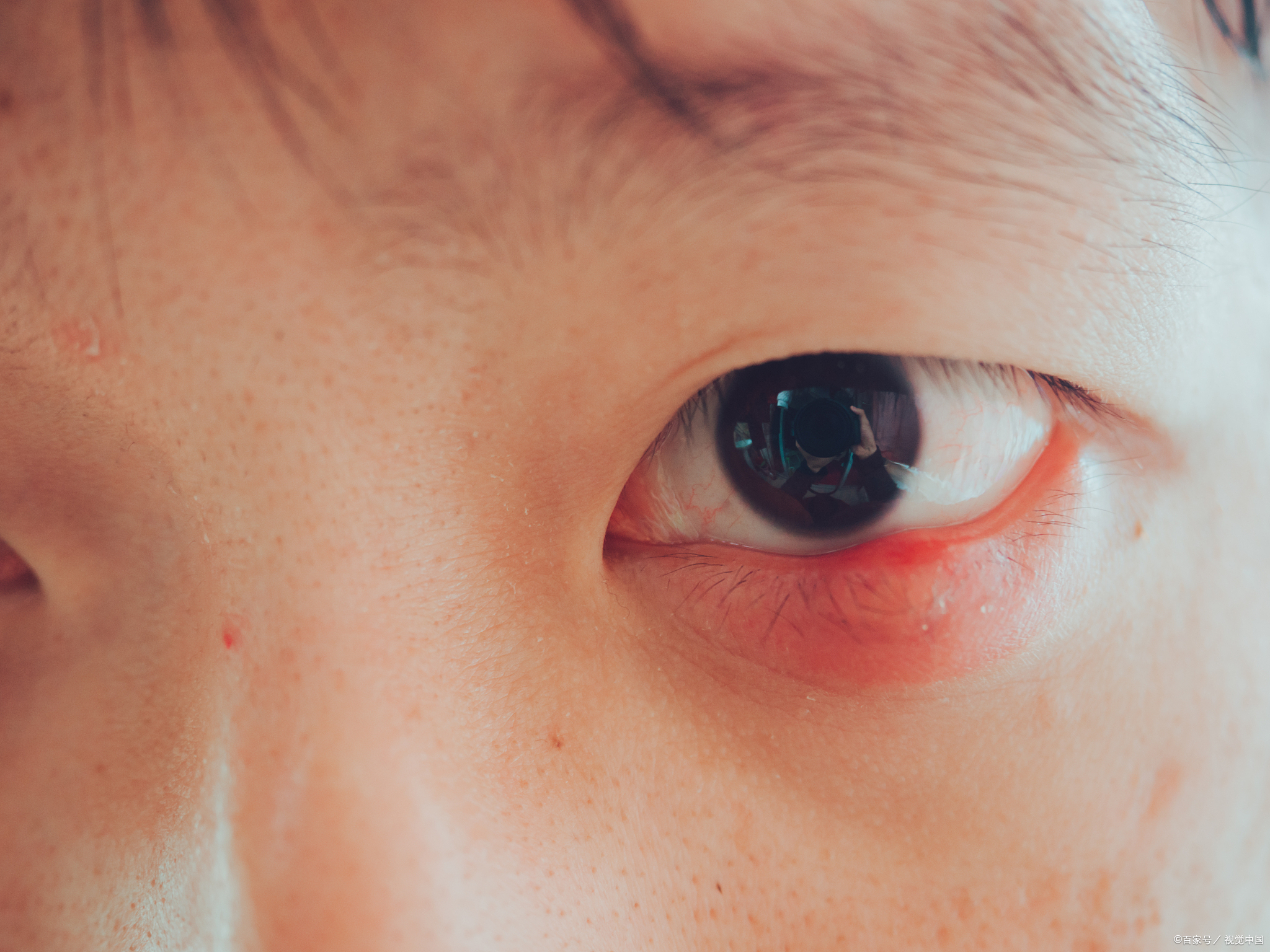 石灰烧伤眼睛是一种严重情况,需要快速处理以减少伤害