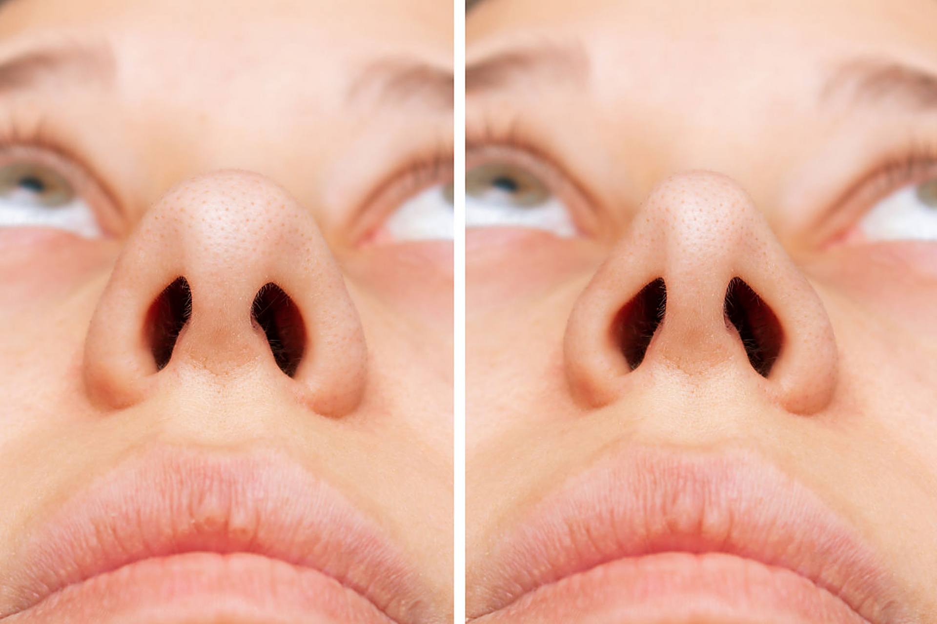 鼻综合手术后鼻头特别大怎么办?