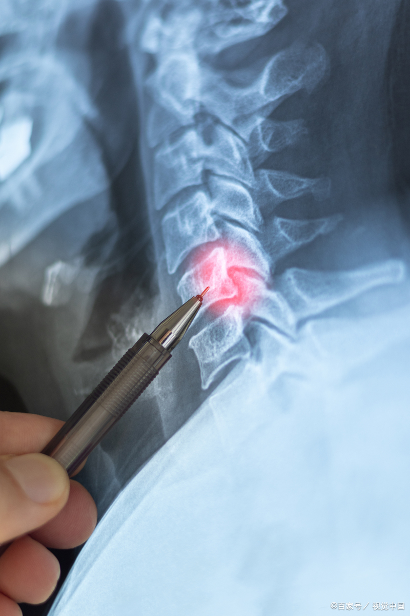 颈椎ct和x光都是常见的影像学检查手段,但它们的