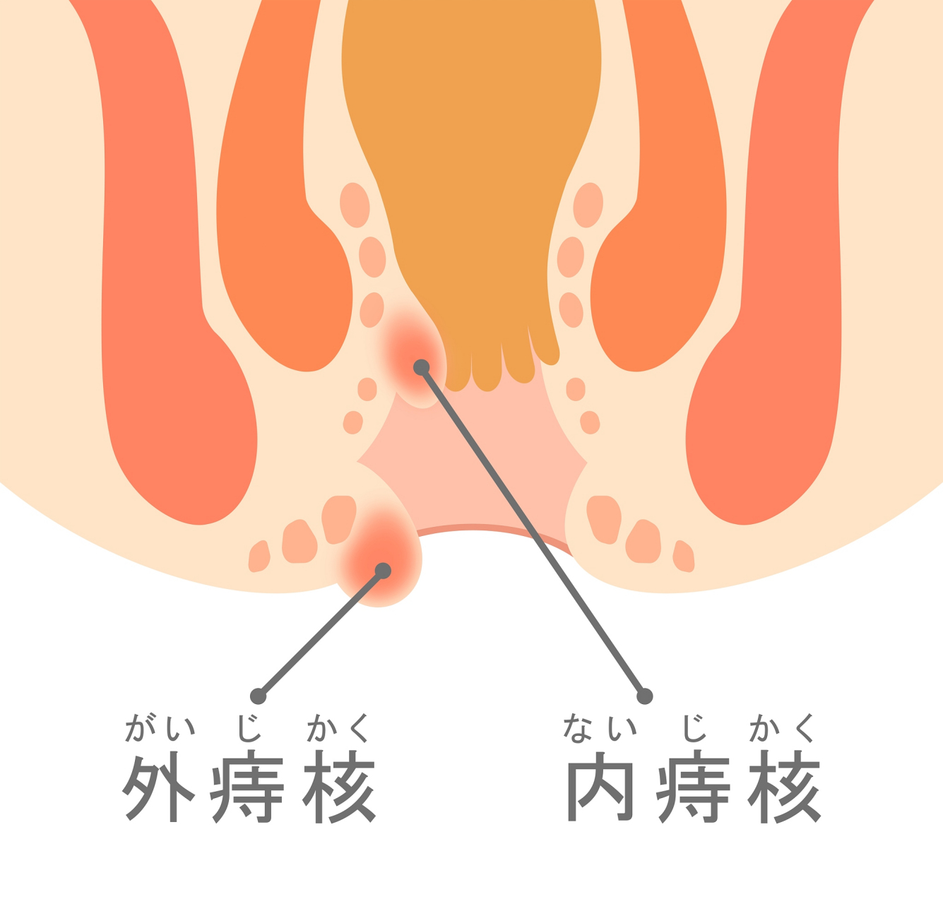 常规手术:在常规手术中,医生会使用手术刀或电刀切除痔疮组织.