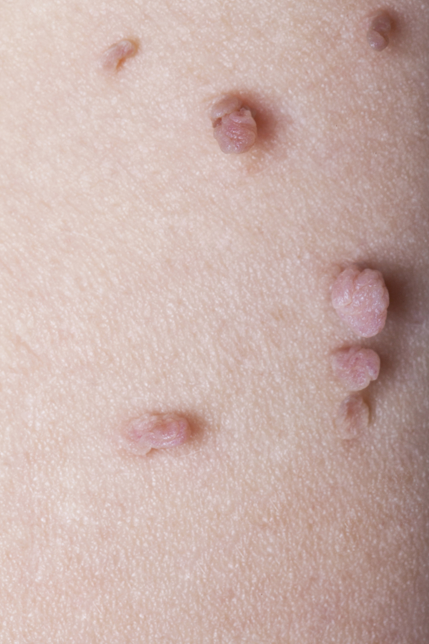 皮肤上出现菜花状的疣通常是由人乳头瘤病毒(hpv)感染引起的,与疤滋