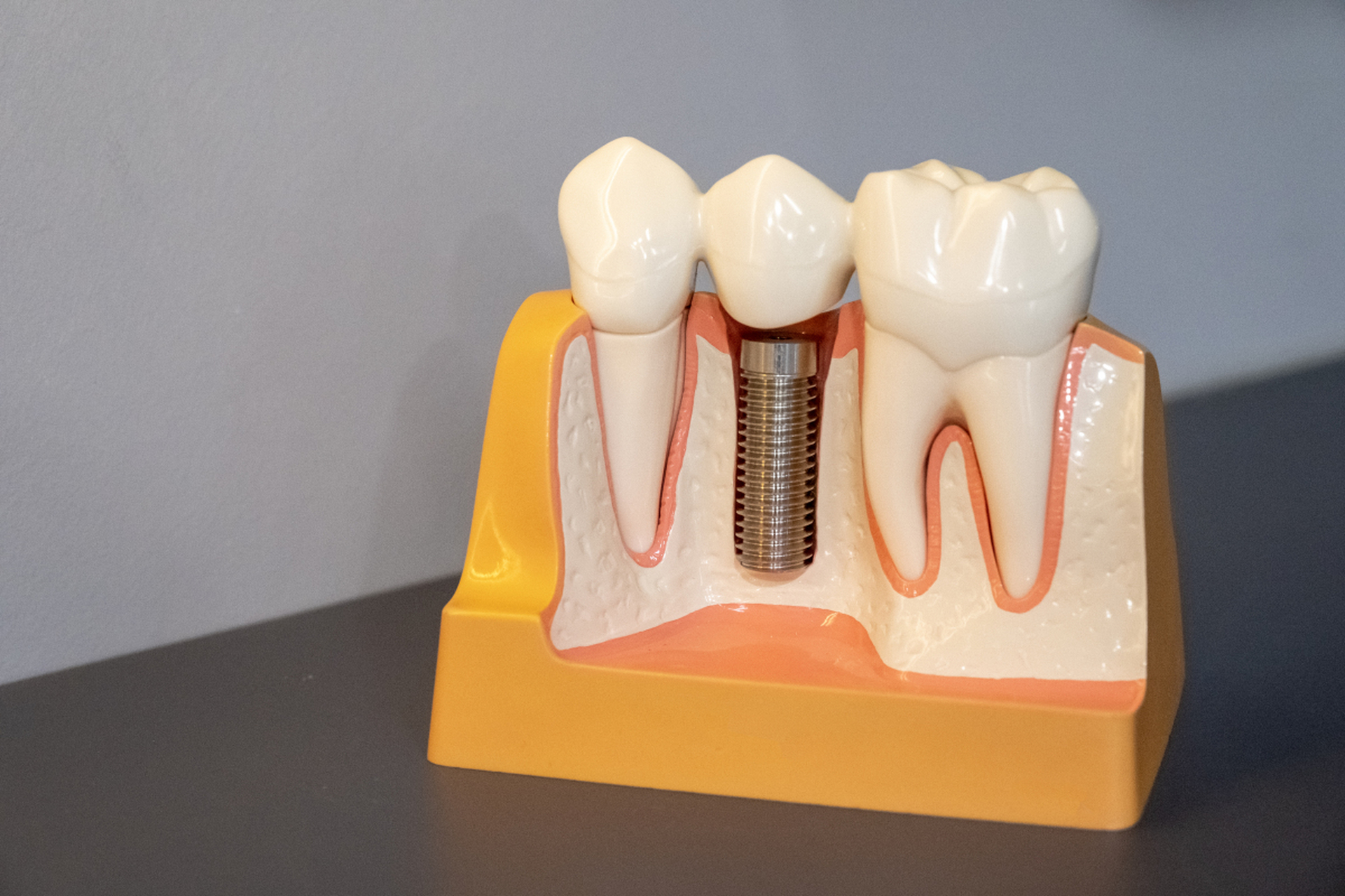 牙博士种植牙价格?