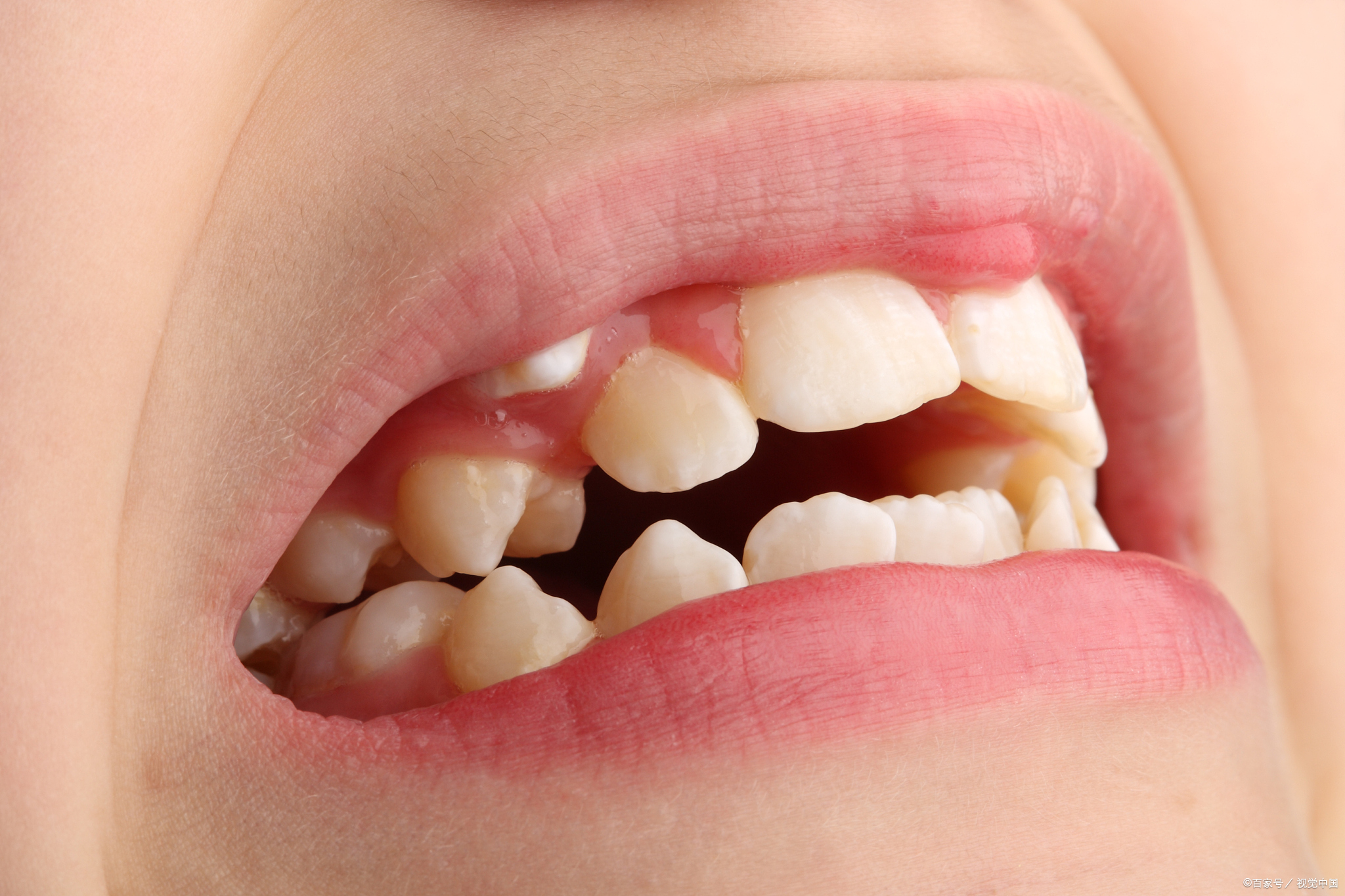 【正畸】  微微突出,俏皮可爱的小虎牙,它们似乎为笑容增添了几分个性
