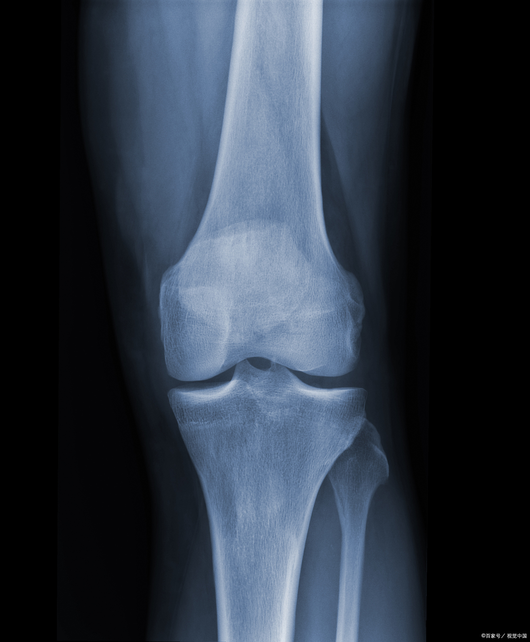 膝关节软骨磨损会怎么样