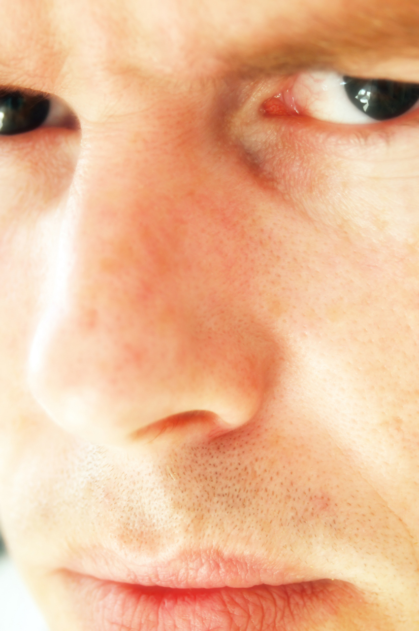 鼻子皱皮症图片