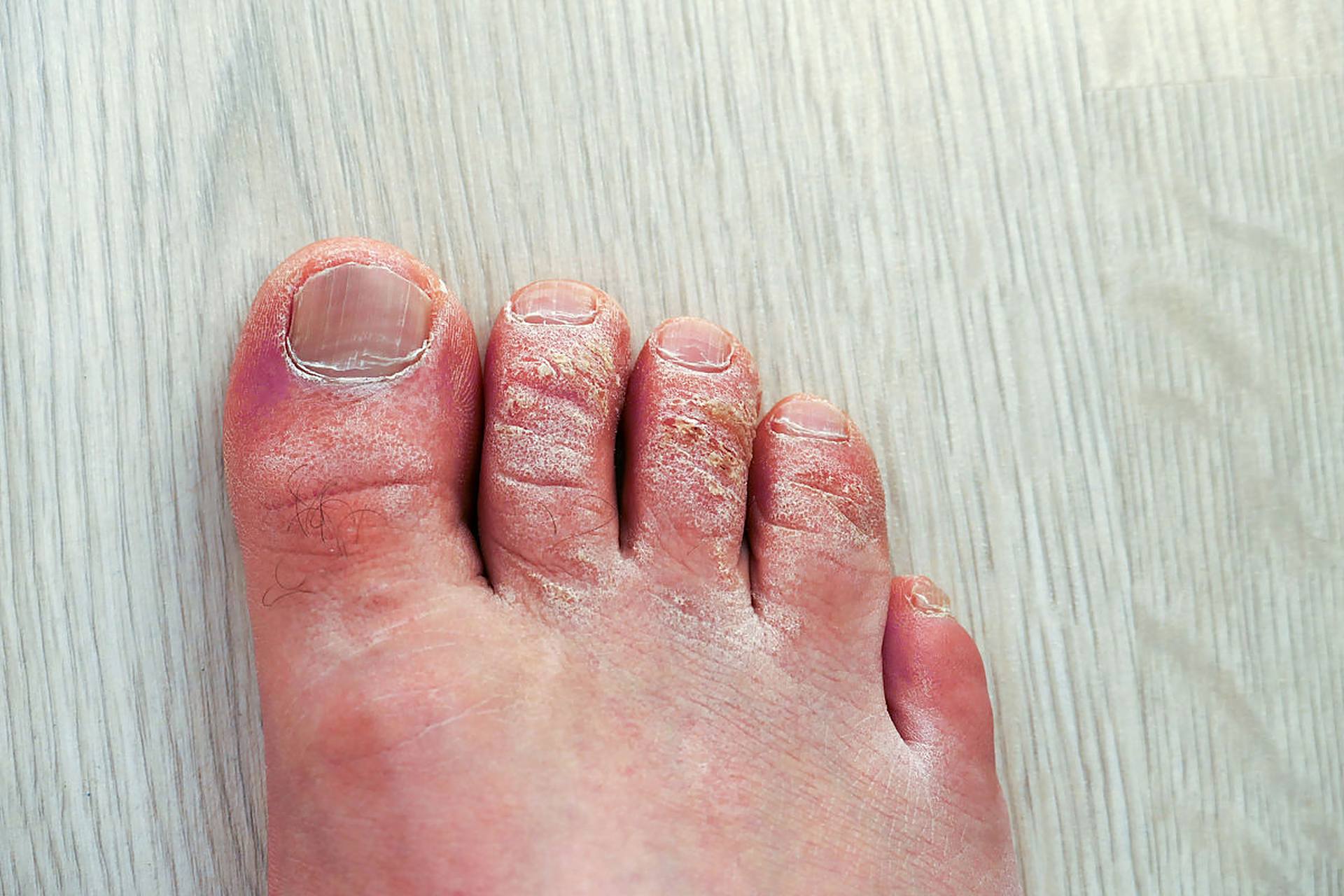 98水疱型脚气,这个看似小问题的皮肤疾病,实则给患者带来不小的