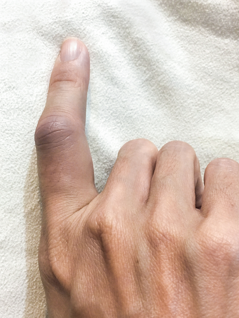氢氟酸烧伤手指肿胀图片