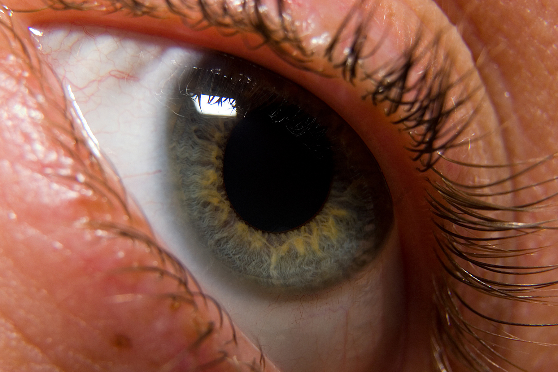 过敏性结膜炎是一种眼部炎症,通常是由过敏原引起的.