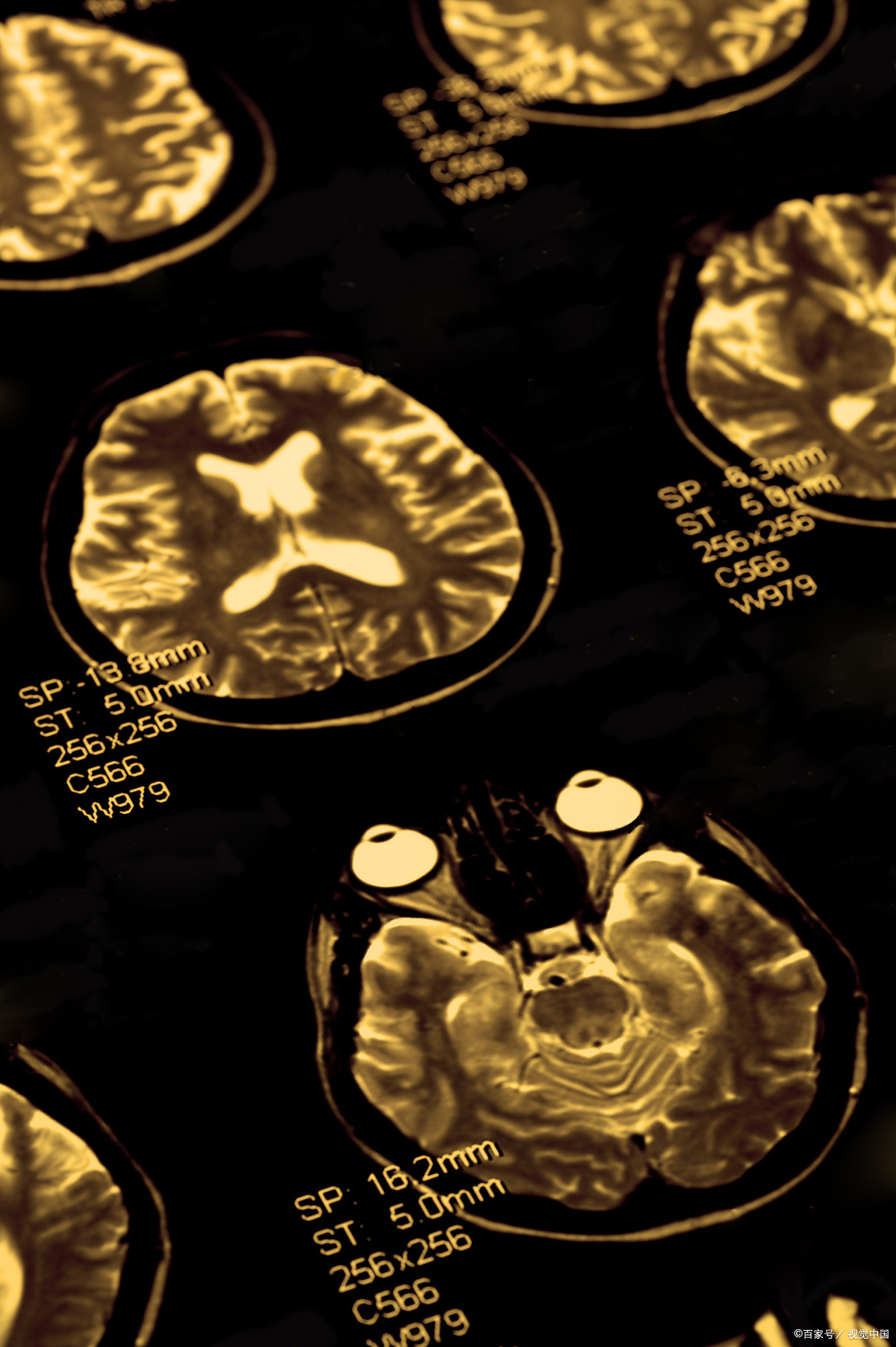 包含航天总医院检查加急核磁(MRI)到底有什么区别?的词条