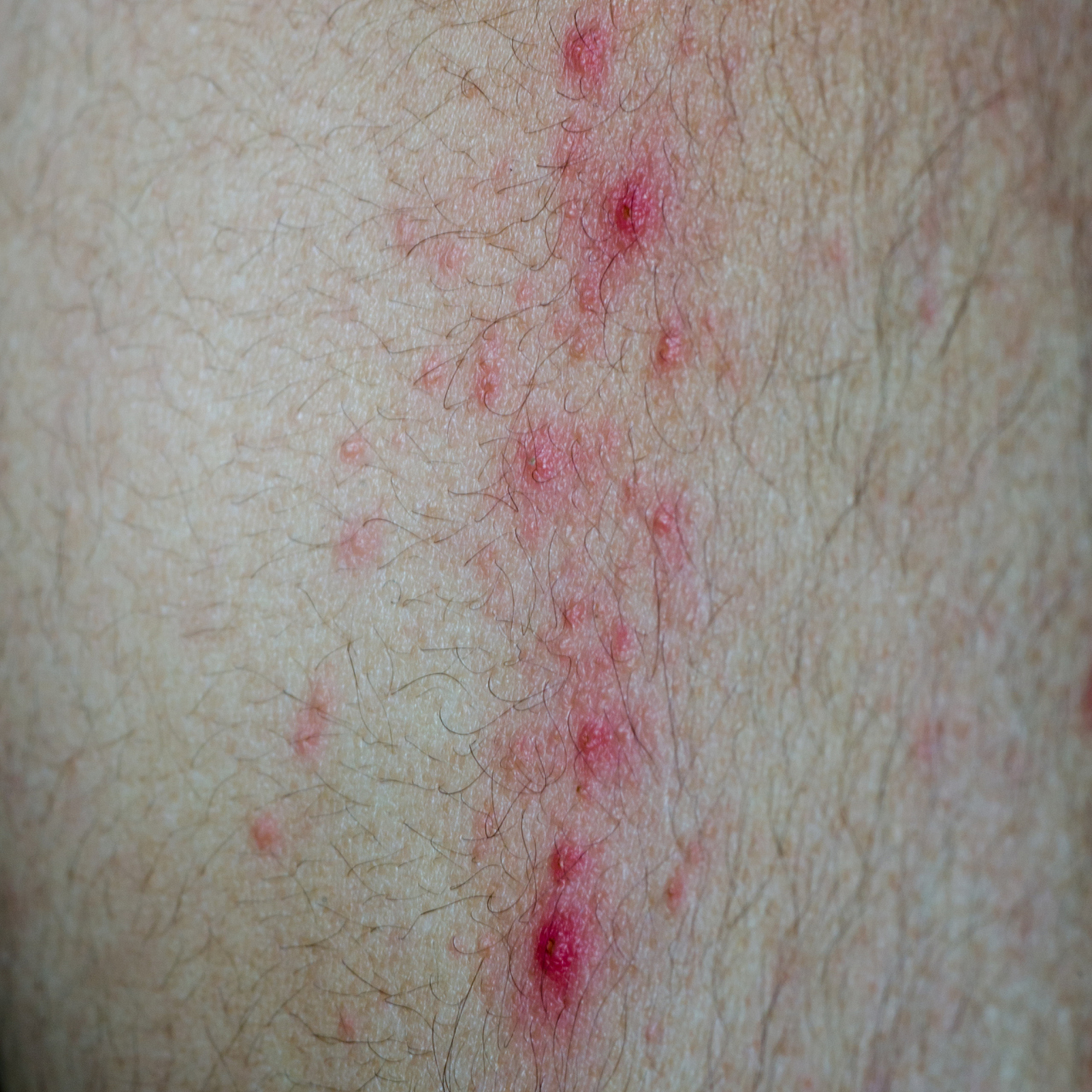 阴茎脱皮可能是阴茎清洁不当,过度抓挠,阴囊湿疹等因素导致的,建议