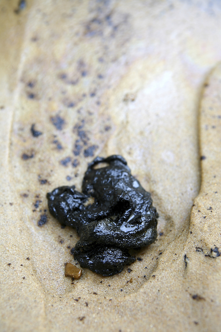 和黑便的情况,通常表明患者已经出现了严重的并发症,特别是消化道出血