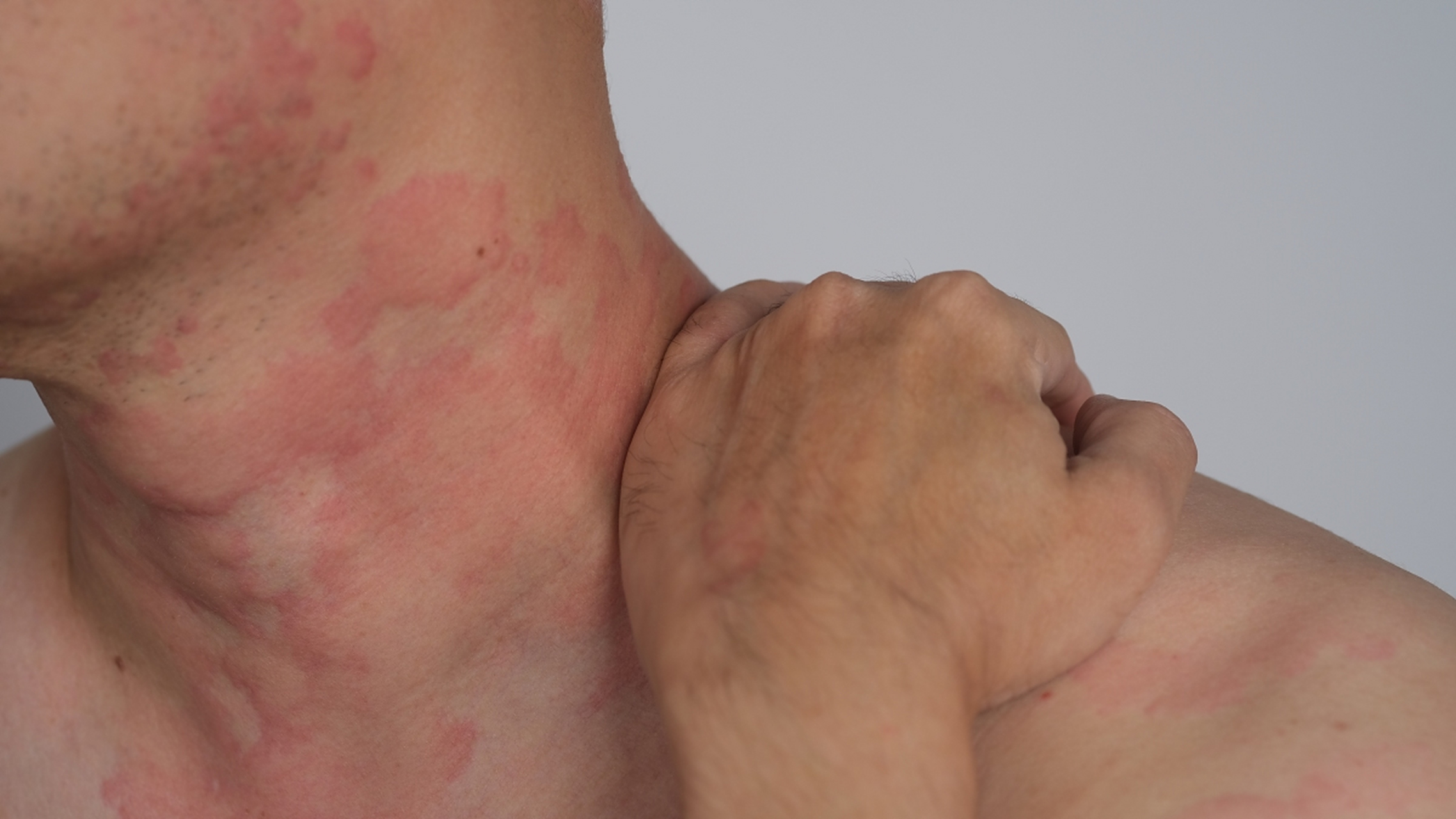 得了荨麻疹怎么办?