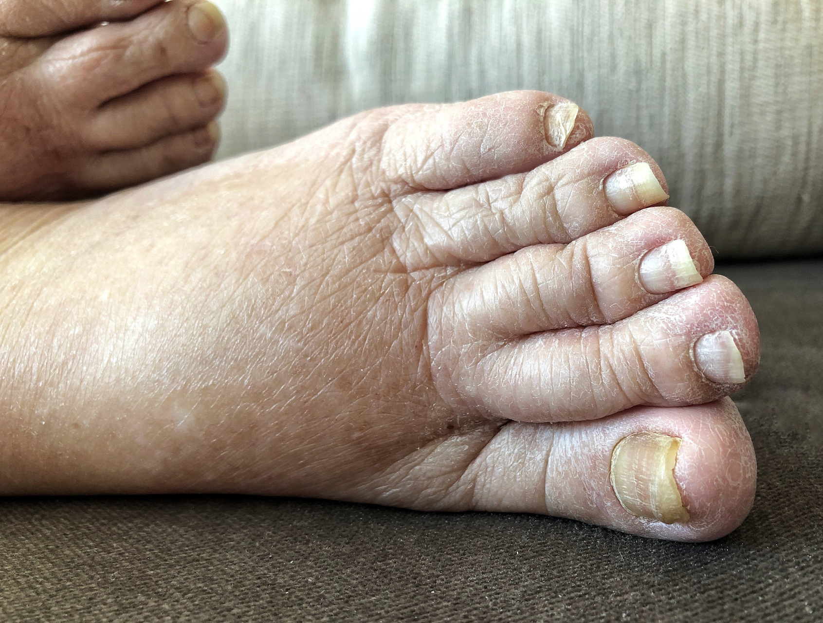 手足藓#手足藓(tinea manuum pedum)是一种由真菌感染引起的皮肤病