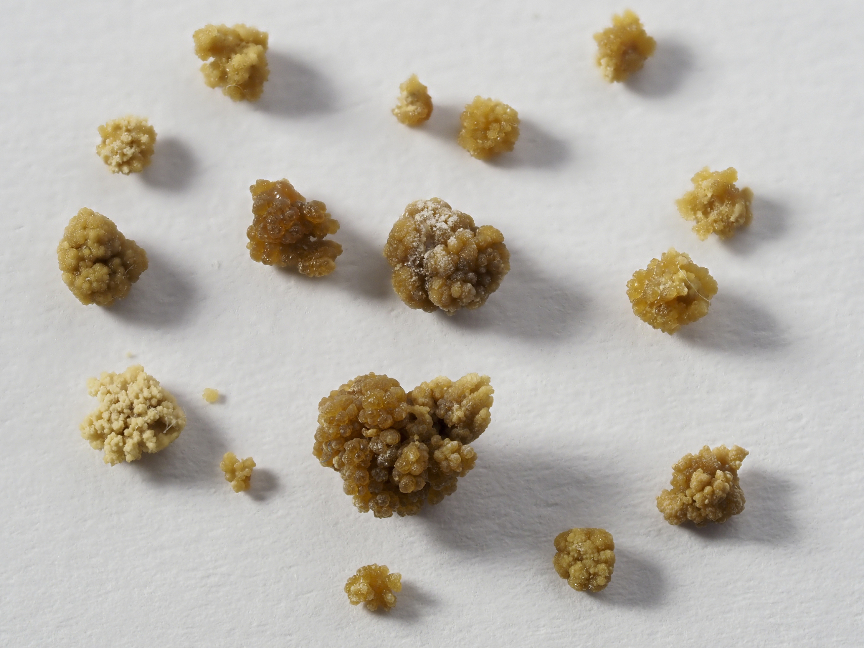 尿液检查能不能查出肾结石? 是可以的!