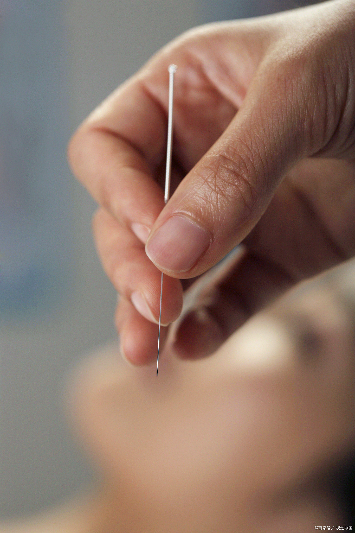 颈椎病的中医针灸治疗