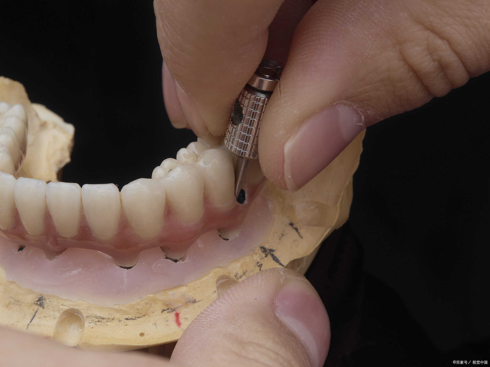 想知道从缺牙到拥有新牙,种植牙的全流程需要多久吗?